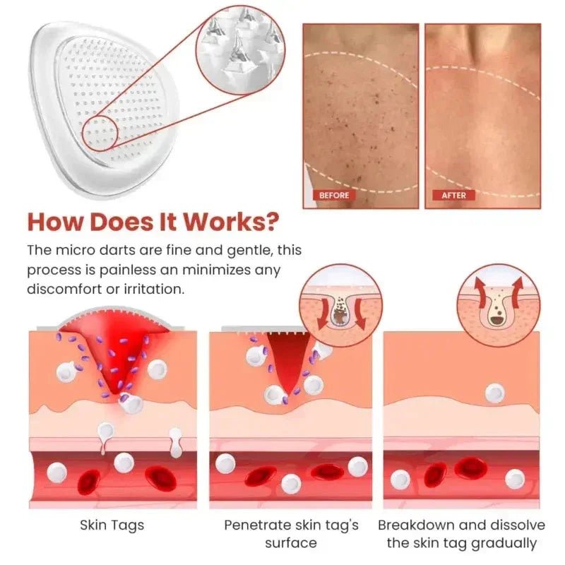 Derma Smooth Skin Tag Removal Patch - ✨ 100% Results - Ummati_Essentials